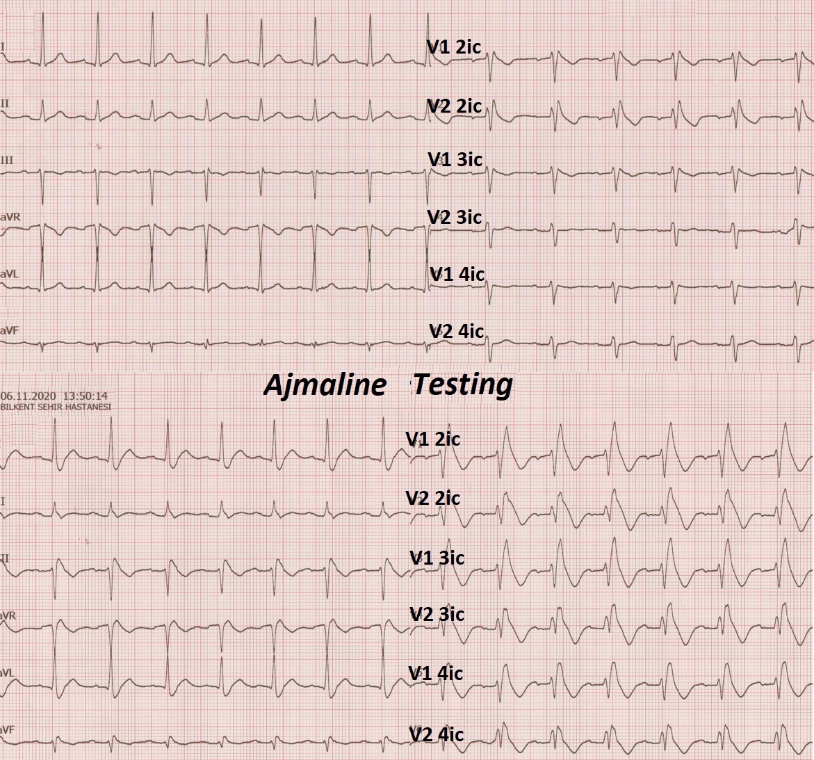 Yuksek Ihtisas Arrhythmia- Ankara City Hospital (@ach_epteam) on Twitter photo Ajmaline-induced➡️BrS or RBBB, or both?..
<a href="/HabibeKafes/">habibe kafes</a> <a href="/iremdilaracan/">diloş</a> <a href="/Mkara_EP/">Mkara</a> <a href="/ElifhandeMD/">Elif Hande Özcan Çetin</a> <a href="/AhmetKorkmaz07A/">Ahmet</a> <a href="/drfiratozcan/">Fırat Özcan</a> <a href="/prof_serkan_cay/">Prof Dr Serkan Cay</a> <a href="/ozcanozeke/">Özcan Özeke</a> <a href="/DursunAras2/">Dursun Aras, Professor</a> <a href="/topaloglu_prof/">Serkan Topaloglu, MD</a> <a href="/EF_Cardiaca/">EfectoElectrotónico</a> <a href="/Pedrobrugada/">Pedro Brugada</a> <a href="/adribaran/">Adrian Baranchuk MD FACC FRCPC FCCS FSIAC</a> <a href="/MoussaMansour10/">Moussa Mansour</a>
doi.org/10.19102/icrm.… <a href="/JICRM/">JICRM</a> Ajmaline-induced➡️BrS or RBBB, or both?..
<a href="/HabibeKafes/">habibe kafes</a> <a href="/iremdilaracan/">diloş</a> <a href="/Mkara_EP/">Mkara</a> <a href="/ElifhandeMD/">Elif Hande Özcan Çetin</a> <a href="/AhmetKorkmaz07A/">Ahmet</a> <a href="/drfiratozcan/">Fırat Özcan</a> <a href="/prof_serkan_cay/">Prof Dr Serkan Cay</a> <a href="/ozcanozeke/">Özcan Özeke</a> <a href="/DursunAras2/">Dursun Aras, Professor</a> <a href="/topaloglu_prof/">Serkan Topaloglu, MD</a> <a href="/EF_Cardiaca/">EfectoElectrotónico</a> <a href="/Pedrobrugada/">Pedro Brugada</a> <a href="/adribaran/">Adrian Baranchuk MD FACC FRCPC FCCS FSIAC</a> <a href="/MoussaMansour10/">Moussa Mansour</a>
doi.org/10.19102/icrm.… <a href="/JICRM/">JICRM</a>