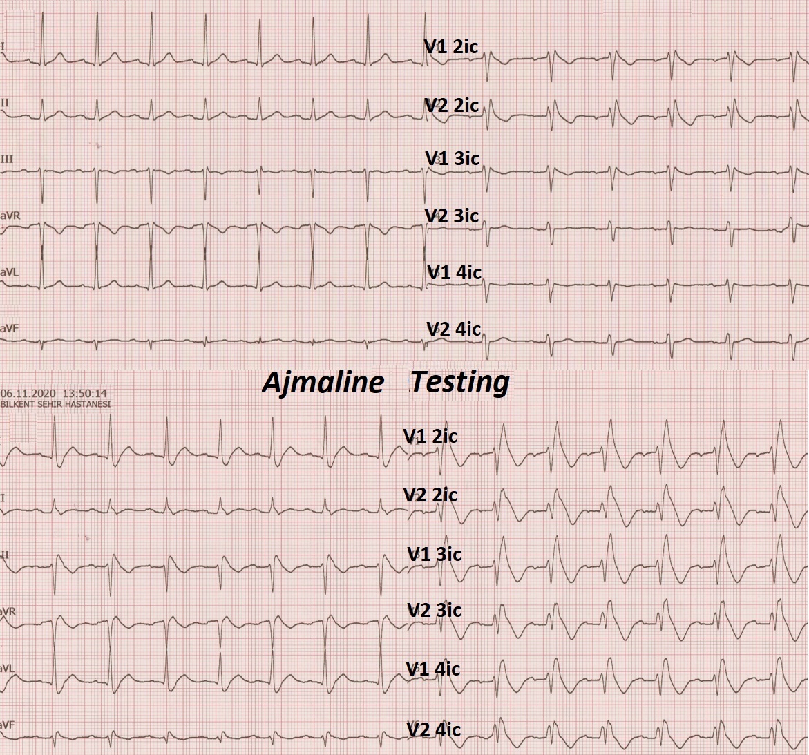 Ajmaline-induced➡️BrS or RBBB, or both?.. @HabibeKafes @iremdilaracan @Mkara_EP @ElifhandeMD @AhmetKorkmaz07A @drfiratozcan @prof_serkan_cay @ozcanozeke @DursunAras2 @topaloglu_prof @EF_Cardiaca @Pedrobrugada @adribaran @MoussaMansour10 doi.org/10.19102/icrm.… @JICRM