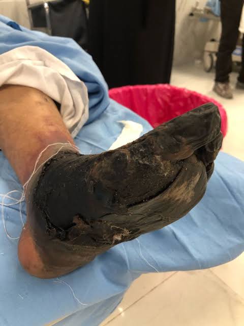 GYerathel's tweet photo. Uncontrolled diabetes mellitus that let into diabetic foot https://t.co/atBk1Xv3u6