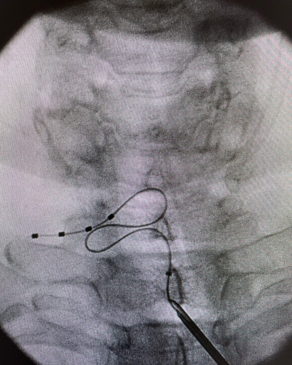 2 months since C8 DRG implant for  pain vascular injure due Raynoud Syndrome. Patient with 0-1 VAS. Injure resolving.  A new indication with great expectations