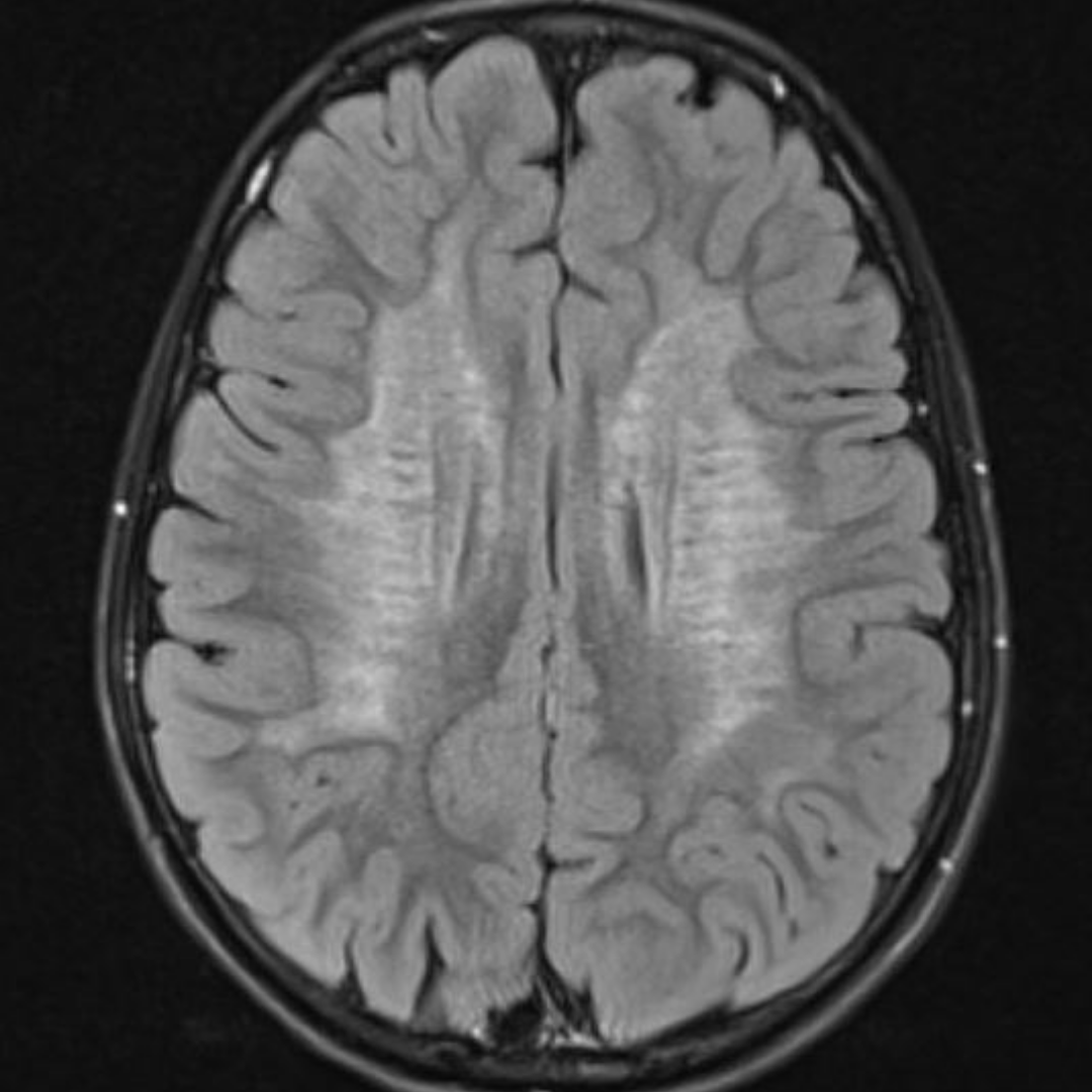 NeuroimagingN's tweet photo. Metachromatic leukodystrophy
·
Autosomal recessive. Mutation in the ARSA gene leads to arylsulfatase A deficiency. Lysosomal storage disease.
·
U-fibers are initially spared

#metachromaticleukodystrophy #arylsulfataseadeficiency #lysosomalstoragedisorder #neurology #Pediatrics https://t.co/gD33ZehVly