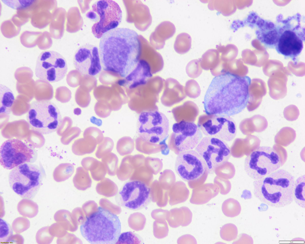 Sanam Loghavi, MD صنم لغوی 🔬🧬 tweet media