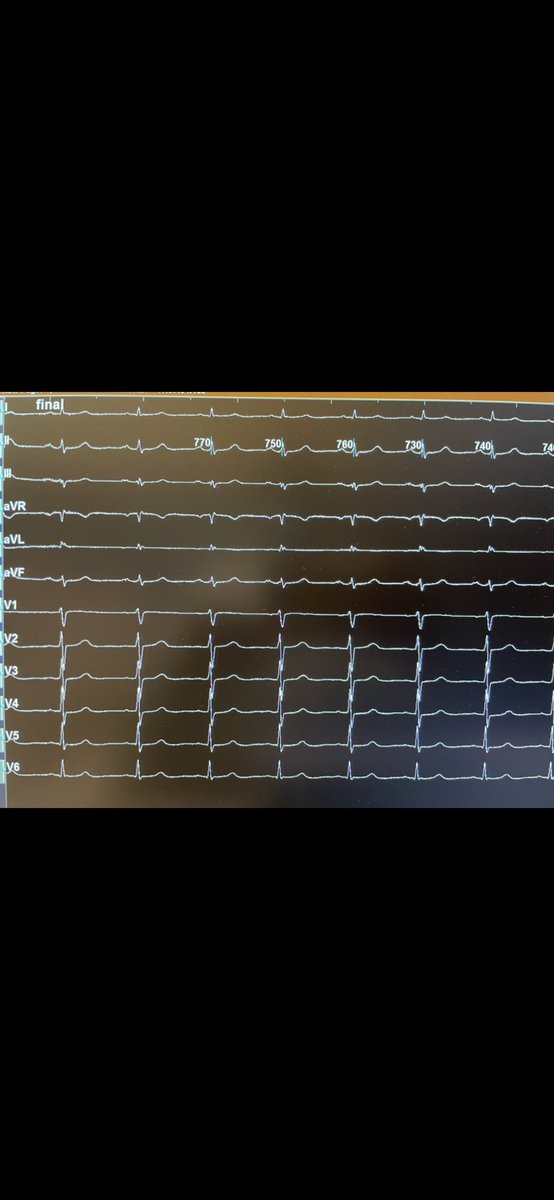 rfablation's tweet photo. #EPeeps #RVOT incessant ectopic beats in M40YO quickly mapped by HD Grid and effectively gone after few seconds RF in antero-basal RVOT by TactiCath catheter #ZeroFluoro @PaoloDellaBell1 @messapus @DrRoderickTung https://t.co/ieYvJ8ycPX