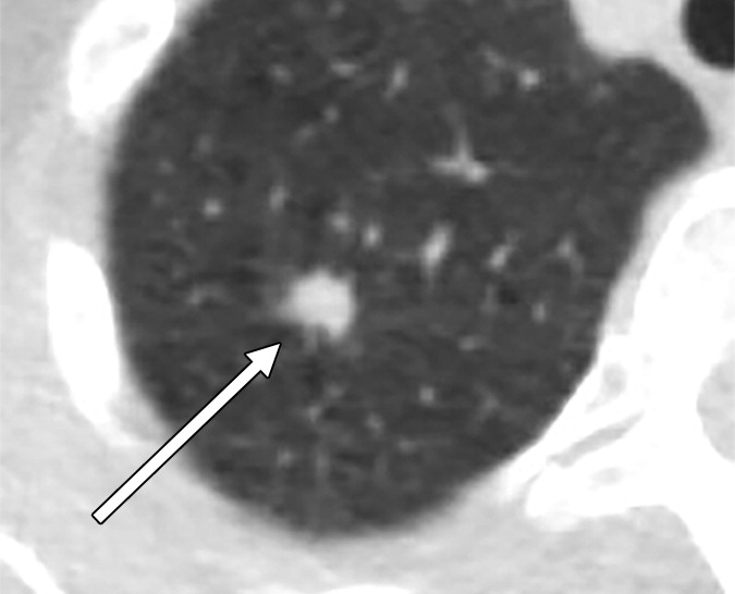 AJR_Radiology's tweet photo. As malignant nodules are slow to manifest growth, 3-month follow-up CT has limited yield, and 3-month stability should not be considered assurance of benignancy.

https://t.co/yTOPQkc8wL https://t.co/OCpNsyst1N
