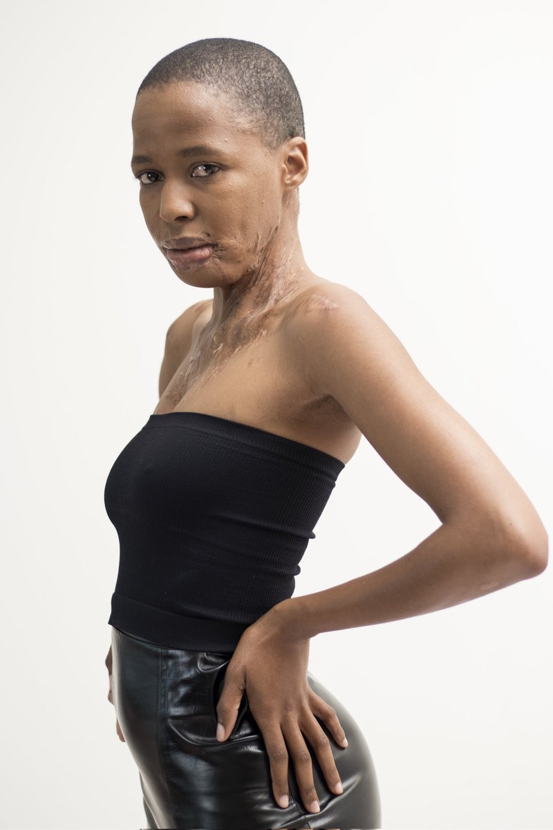 eva_rakitla's tweet photo. Diversity &amp; Inclusion

Advocating for diversity and inclusion of people with scars in the fashion, modelling and beauty https://t.co/UZN2mhczyH scars are my brand and my brand is my scars.
💄@ThaBangArtistry 
📸 @raymondplusraymond 

#modelwithscars #scarstoyourbeautiful https://t.co/gtgV0m2I1V