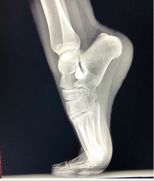 HyProCure's tweet photo. #repost “#Limitations after #HyProCure placed into the sinus tarsi. Wearing #high heels should not be an issue once healing has occurred. Ballet should not be a problem once fully recovered. Thanks #HyProCure. To learn more https://t.co/Z71ziXfqVR” #hyprocureimplant #footpain https://t.co/kNoFO19NCf