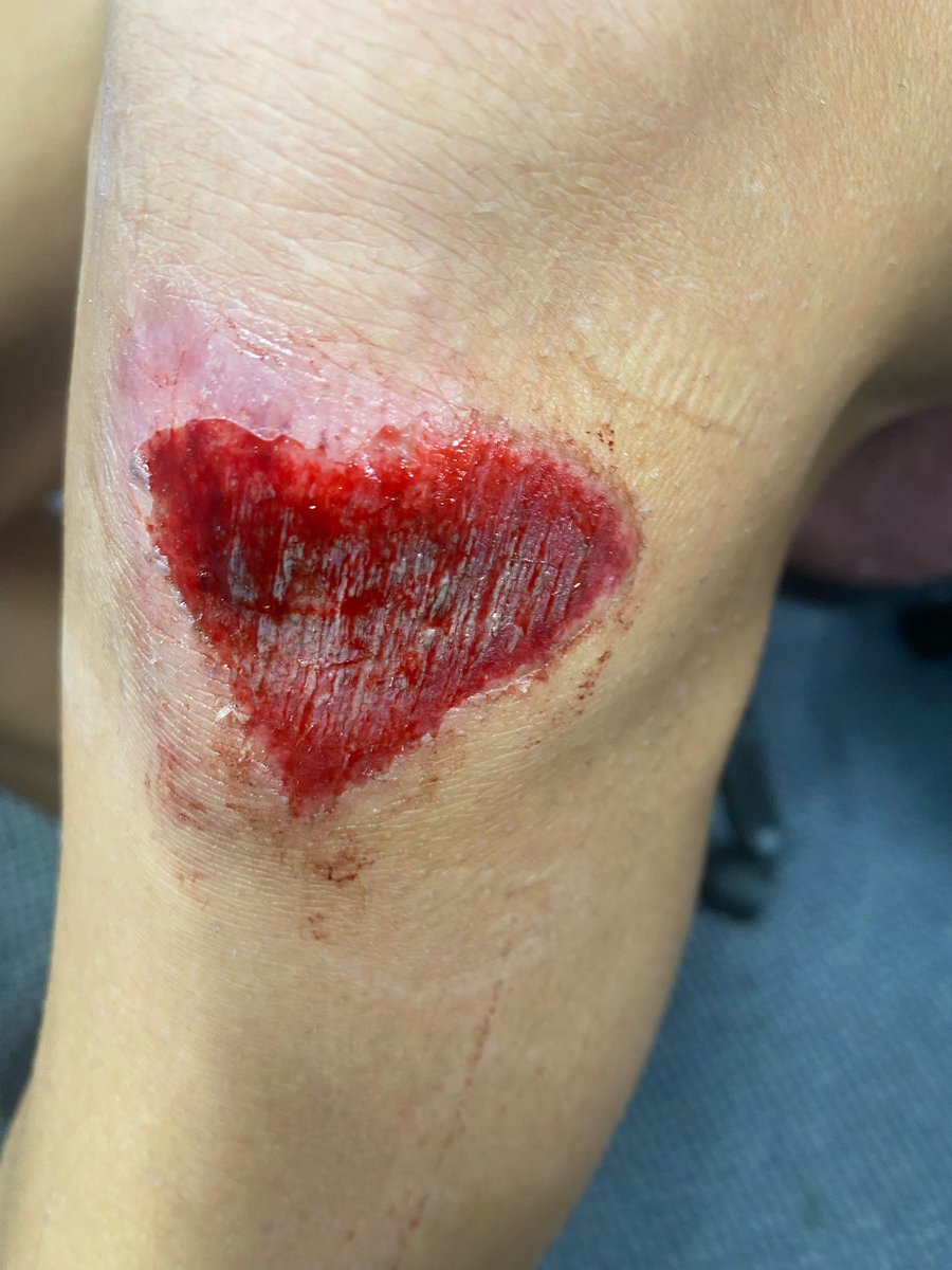 If a heart shaped skinned knee isn’t something to celebrate, I don’t know what is.