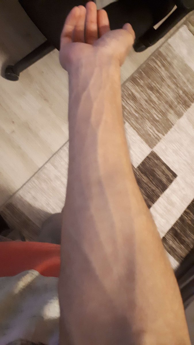 _EBKey's tweet image. I went to the hospital to give blood for a stupid certificate. How could you not find a vein in this arm in 3 TRIESA_dsa?