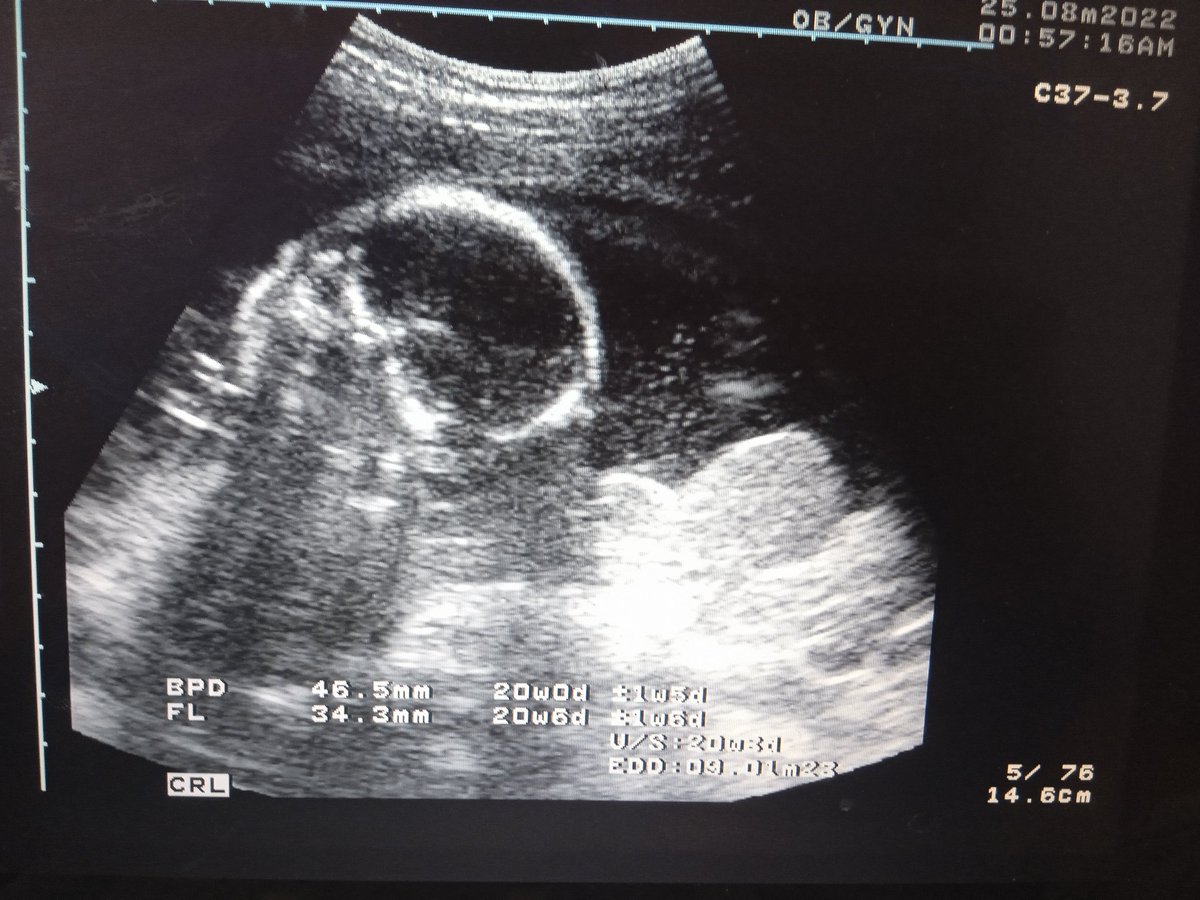 Los hallazgos ecográficos ayudan a un mejor diagnóstico y tratamiento en los pacientes. En el <a href="/BicentenarioBo/">CDI Bicentenario</a> se presta este servicio con excelencia. #CubaPorLaSalud <a href="/Cubacooperabol2/">Brigada Médica 🇨🇺 Bolívar🇻🇪</a> <a href="/cubacooperaven/">Brigada Médica Cubana en Venezuela</a> <a href="/AdanVillavicen5/">Adan Villavicencio Guzmán</a> <a href="/TapiaRigel/">Rigel Tapia Torres</a> <a href="/Yordany881226/">Yordany</a> .