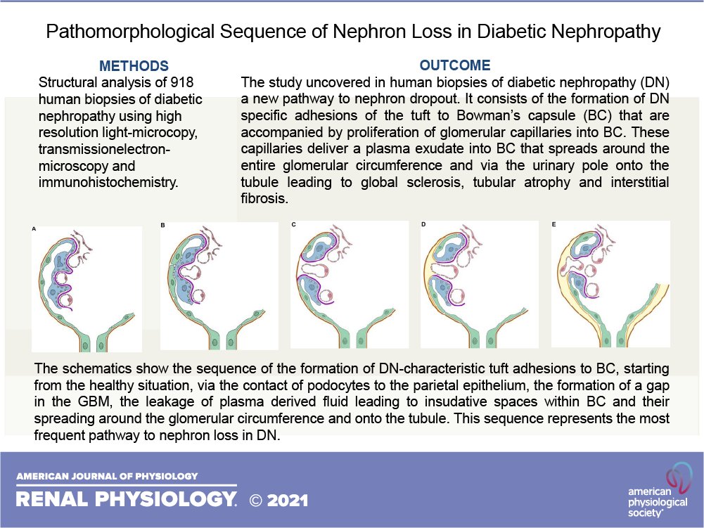 #FreeArticleOfTheWeek
Pathomorphological sequence of nephron loss in #DiabeticNephropathy
By: Jana Löwen, et al.
ow.ly/AuK750KIbTF
#AJPRenal #TubulointerstitialFibrosis