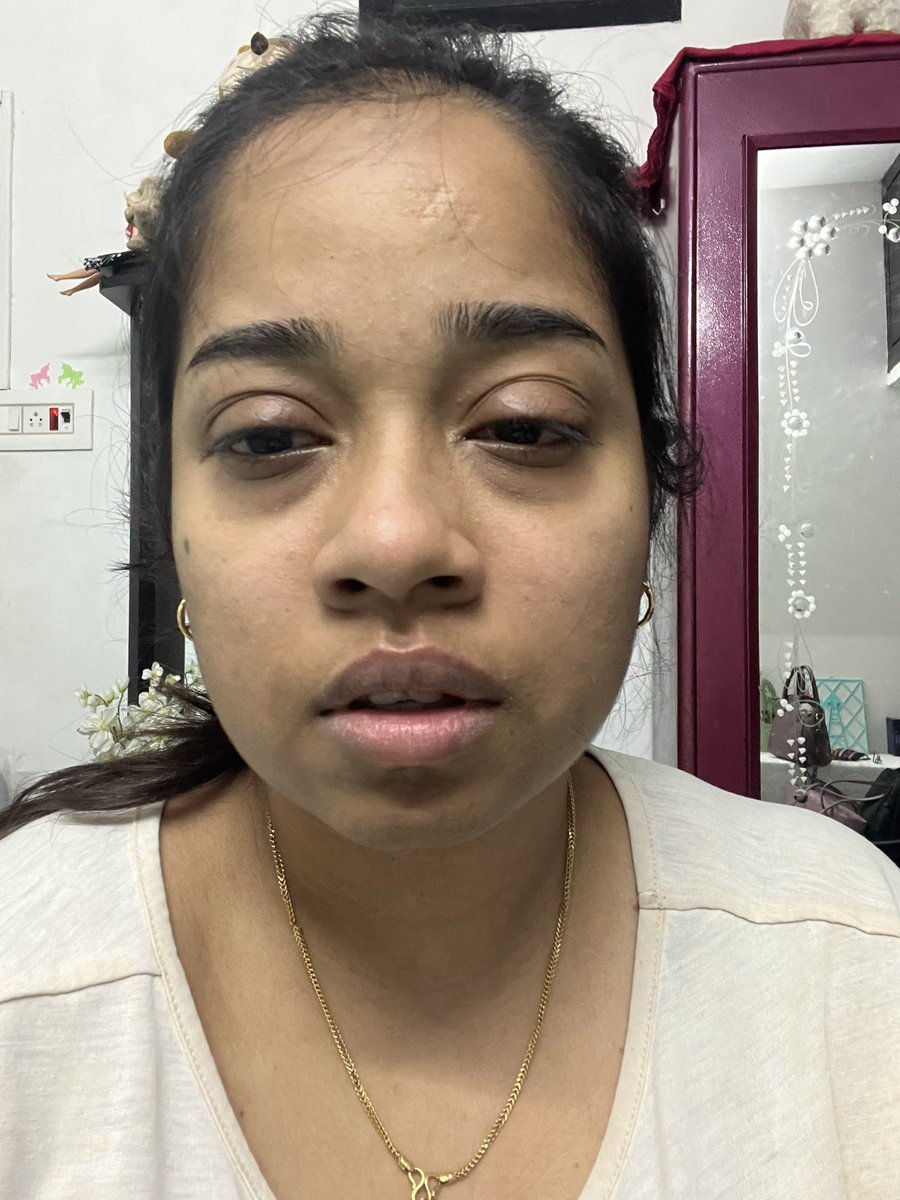 jananiRchandran's tweet photo. This is wat the #Gasleak smell did to my face. My eyes are swollen and itchy. They became red and I’m continuously sneezing. This is gonna kill us all in the long run & when the leakage is high the smell gonna put us in coma or death. Now the time is 2.30am I couldn’t sleep. https://t.co/ZlQIDZC2QH