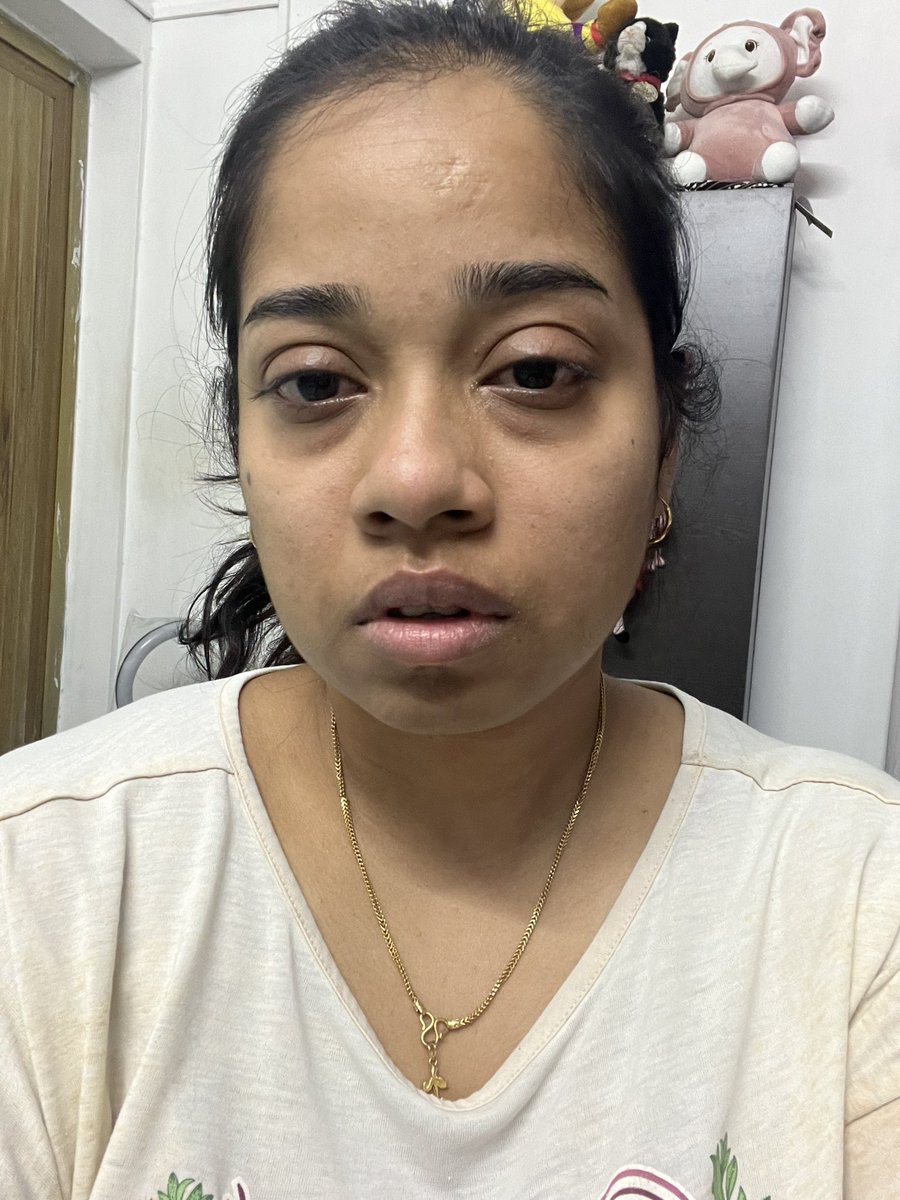 jananiRchandran's tweet photo. This is wat the #Gasleak smell did to my face. My eyes are swollen and itchy. They became red and I’m continuously sneezing. This is gonna kill us all in the long run & when the leakage is high the smell gonna put us in coma or death. Now the time is 2.30am I couldn’t sleep. https://t.co/ZlQIDZC2QH