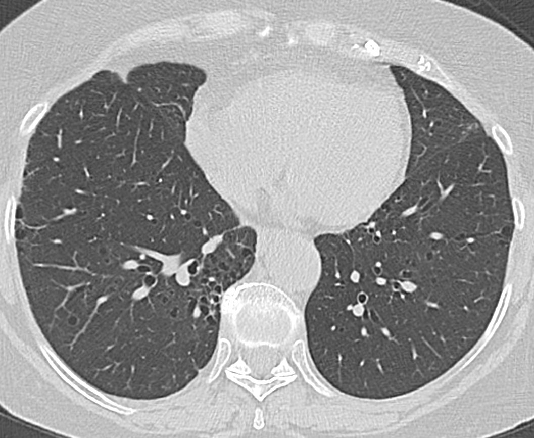 CardiacBronchus's tweet photo. 74y fem. ANCA+ vasculitis. 
Cystic abnormality pattern, clustered and other few random isolated 
It seems ILD related CTD
Question is
Fibrotic pattern?
Subpleural is honeycombing?
I read “LIP w/peripheral cysts due perilymphatic distribution. Your opinion?
Thanks
@jonherochung https://t.co/Pyd4OZz5H2