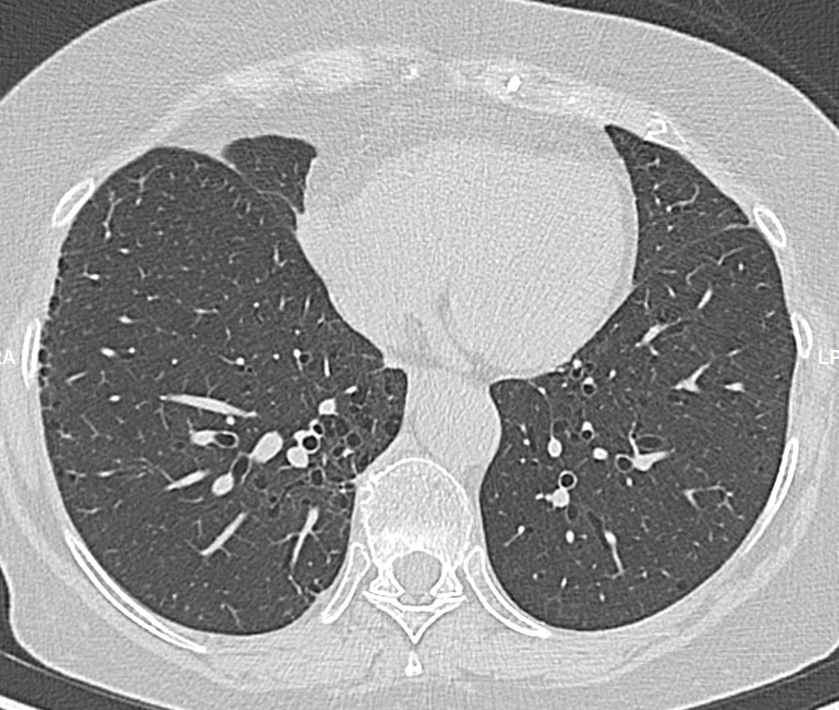 CardiacBronchus's tweet photo. 74y fem. ANCA+ vasculitis. 
Cystic abnormality pattern, clustered and other few random isolated 
It seems ILD related CTD
Question is
Fibrotic pattern?
Subpleural is honeycombing?
I read “LIP w/peripheral cysts due perilymphatic distribution. Your opinion?
Thanks
@jonherochung https://t.co/Pyd4OZz5H2