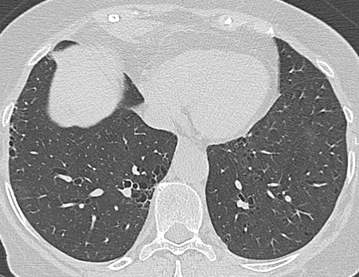 CardiacBronchus's tweet photo. 74y fem. ANCA+ vasculitis. 
Cystic abnormality pattern, clustered and other few random isolated 
It seems ILD related CTD
Question is
Fibrotic pattern?
Subpleural is honeycombing?
I read “LIP w/peripheral cysts due perilymphatic distribution. Your opinion?
Thanks
@jonherochung https://t.co/Pyd4OZz5H2