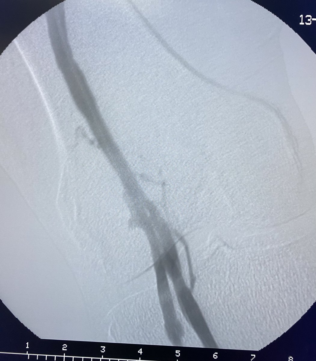 vascularmedic's tweet photo. Great case of thromboaspiration of popliteal DVT with AngioJet system. 💪💪💪 https://t.co/7ghMY25JV4