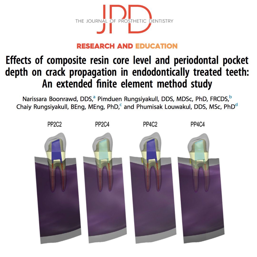 JPDentistry's tweet photo. #finiteelementanalysis is used to assess the influence of #corerestoration design on the survival and maintenance of #teeth with cracks that have undergone #rootcanaltherapy with and without bone loss. Learn more from #theJPD: https://t.co/vmE1NSaAsi https://t.co/lMOQmIsJtn
