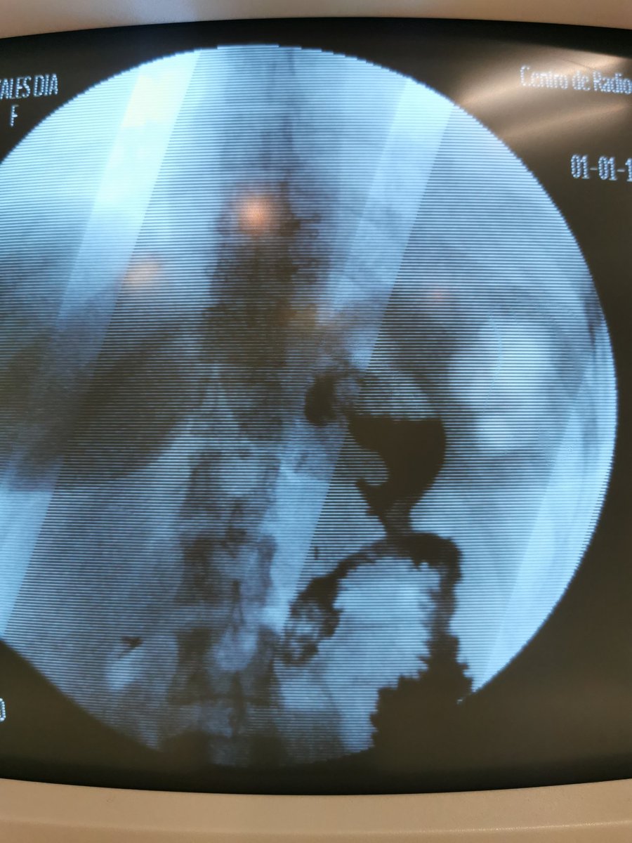 MDArturoRdz's tweet image. Así se ve un #MiniBypass 24 hrs después con medio de contraste.