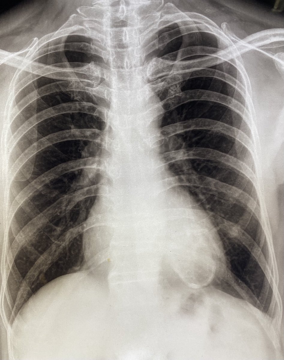 58 year old male admitted with monomorphic VT, negative concordance pattern. Cause ?