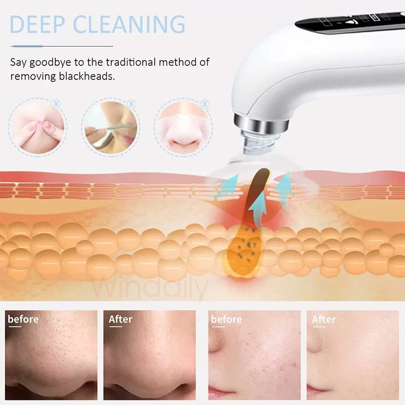 TheGadgetCanada's tweet photo. Smart Blackhead Remover l Electric Micro Bubble Facial Cleansing Machine
5-in-1 Multifunction
Blackhead Remover
Facial Cleanser
Facial Inductor
Shop here: https://t.co/HdxFLzYVoL
#thegadgetstore #smart #Gadgets #fashionista #female #girlsfashion #beauty #facebeauty https://t.co/nJyFoq8yYJ
