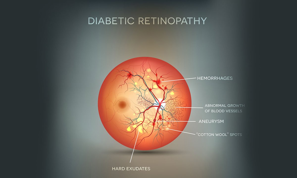 Eating disorders linked to diabetic eye issues 
Share your views in the 2nd World Congress on #diabetes  and #Pediatric #Endocrinology 
✈️#Madrid,#Spain 
📅Oct 17-18,2022
🔗bit.ly/3da85BO
📲+44 7915638336
📩endocrinologyhealthcare6@gmail.com
#WCDPE2022 #EnrollYourselfNow