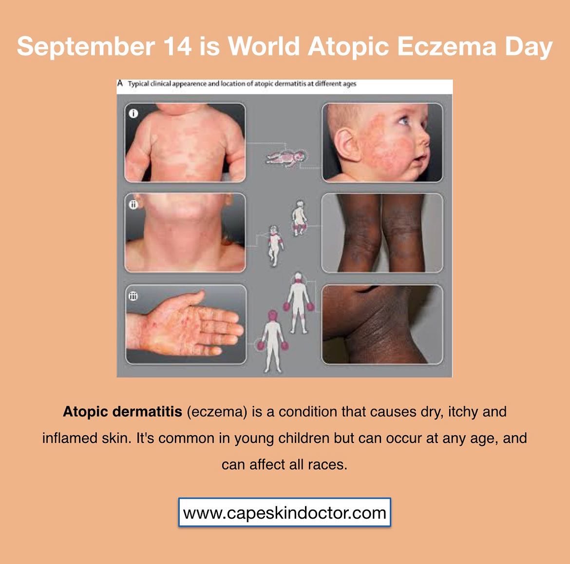 CapeSkinDoctor's tweet photo. World Atopic Eczema Day (14 September), reminds people affected by atopic eczema that they are not alone. You cannot catch eczema, and it is perfectly safe to hold the hand of someone with eczema. #atopiceczema #eczema #WorldEczemaDay #InsideAtopicEczema #EczemaOutreach https://t.co/BGMjXlhE2N