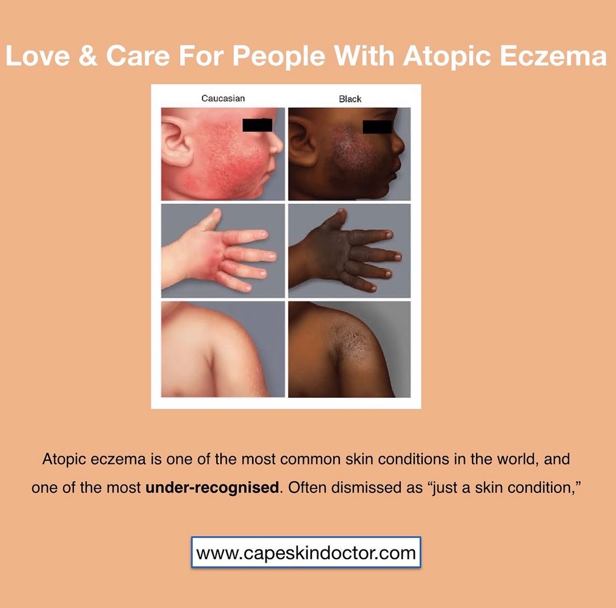 CapeSkinDoctor's tweet photo. World Atopic Eczema Day (14 September), reminds people affected by atopic eczema that they are not alone. You cannot catch eczema, and it is perfectly safe to hold the hand of someone with eczema. #atopiceczema #eczema #WorldEczemaDay #InsideAtopicEczema #EczemaOutreach https://t.co/BGMjXlhE2N