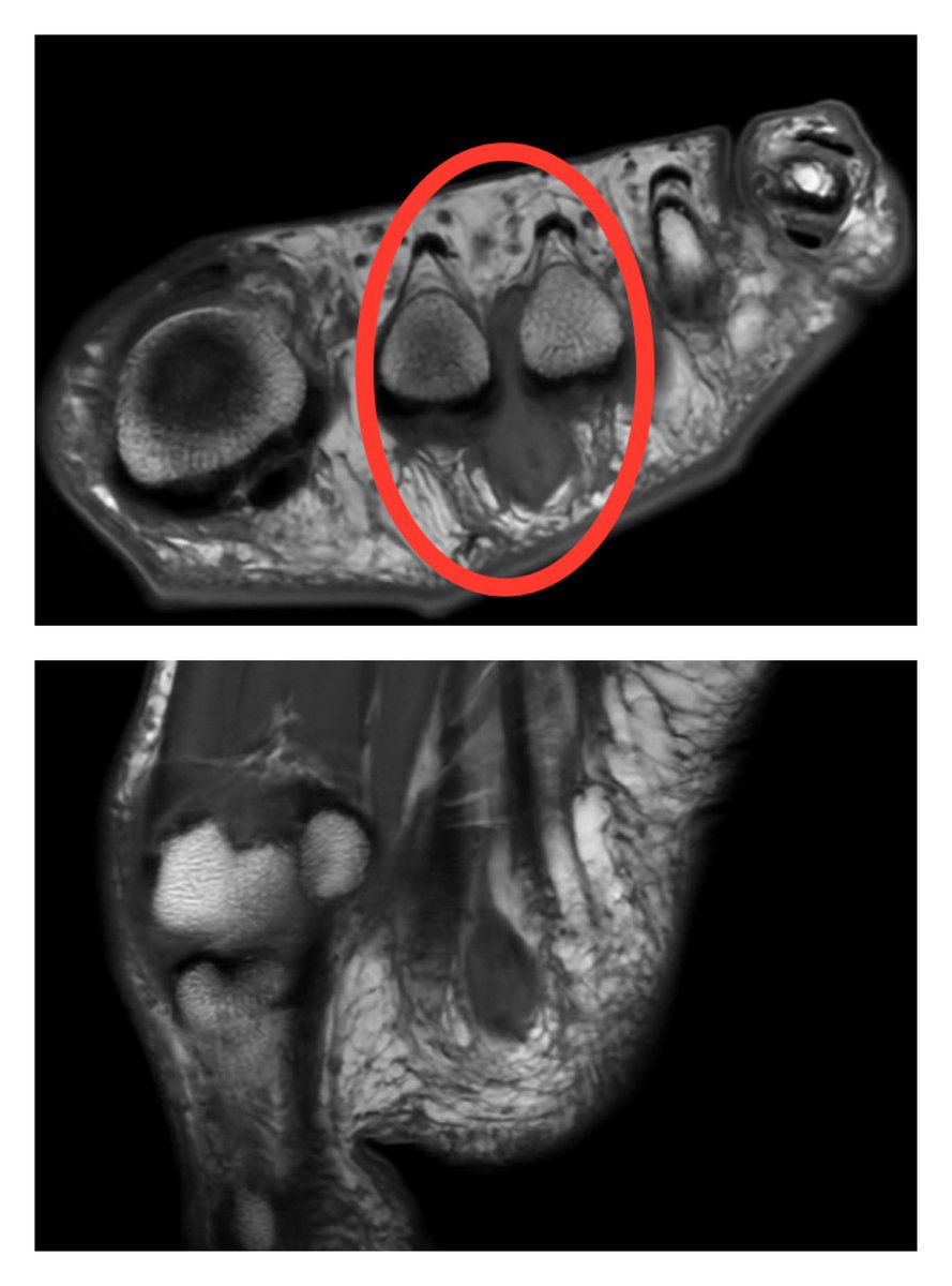 ClinicaCEMTRO's tweet photo. 🦶🏼#NeuromaHauser aparece en el 2º espacio interdigital. Se realiza un diagnóstico diferencial con las siguientes lesiones: 

🔹Placa plantar
🔹Síndrome 2º espacio
🔹Edema óseo
🔹Fractura de estrés
🔹Enfermedad de Freiberg 

Vía @DrSergiohorte | #UdPieYTobillo #ClínicaCEMTRO https://t.co/n8icrwxlLh