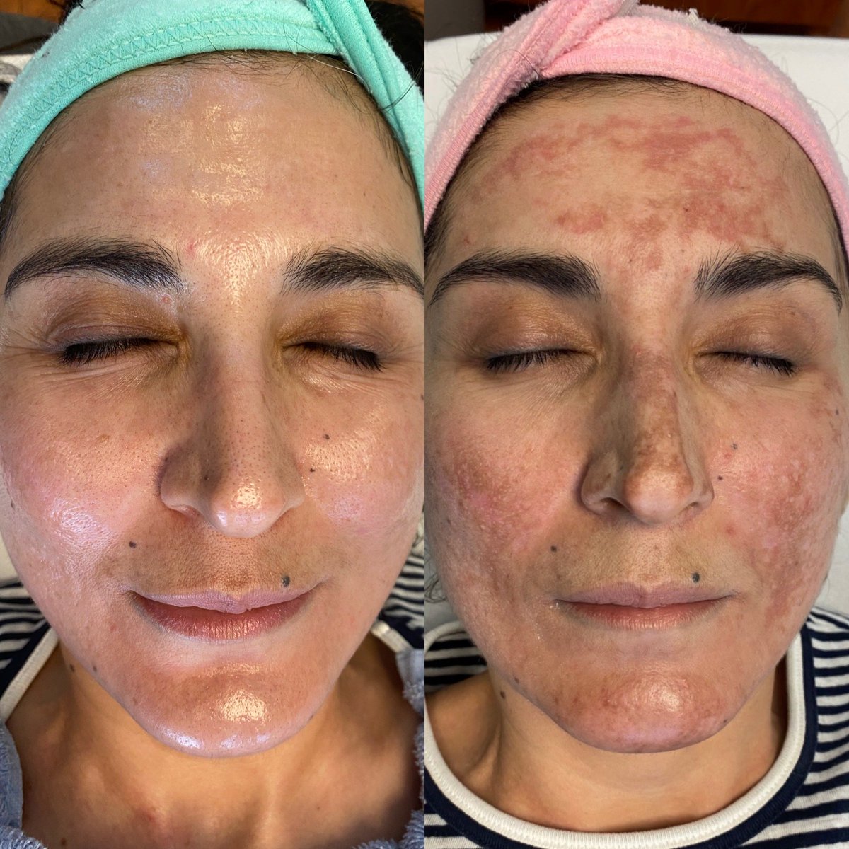 florida_dmc's tweet photo. SecretPRO CO2 Fractional Laser with PRP  Check out these amazing before &amp; afters! 
#nataliesskinsolutions #medicalspa #fortmyers #naples #florida #secretpro #cutera #prp #rfmicroneedling #RF #co2 #co2laser #fractionallaser #pigmentation #skinspa #skincare #facials https://t.co/WplPvVzHZf