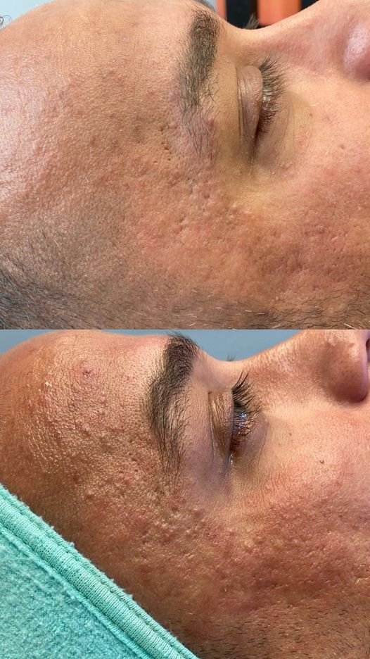 florida_dmc's tweet photo. Look at the progress after only two RF Microneedling Sessions 

RF Microneedling treatments provide deep dermal remodeling, designed specifically to address your needs! 

#CO2 #RF #radiofrequency #microneedle #microneedling #antiaging #skincare #skin #skincaretreatment #secretpro https://t.co/ry6JjCbF2M