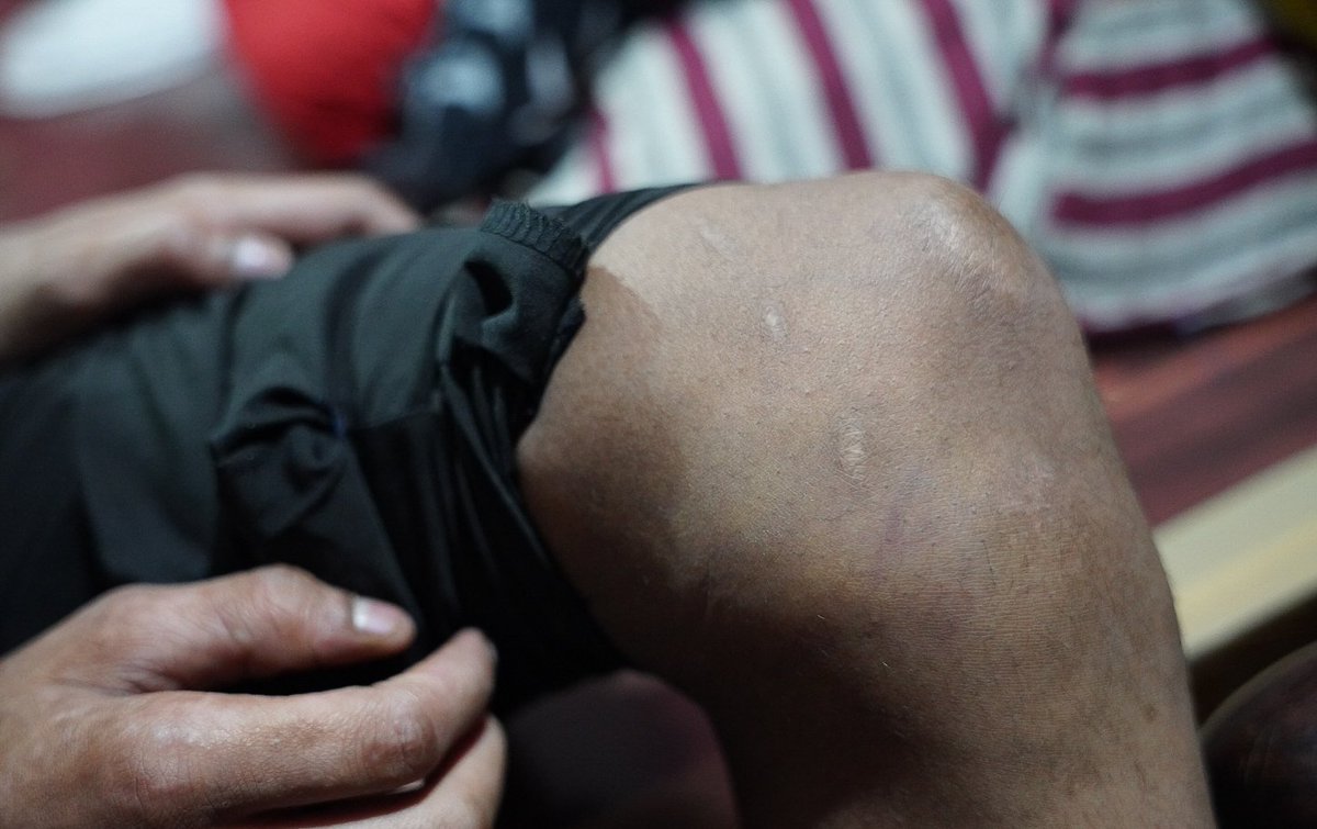meerfaisal01's tweet photo. Rizwan showed me bruises on his body, claiming that the police thrashed him while picking him up from the Madni masjid right after the violence.+ https://t.co/SkWZglQZ2G