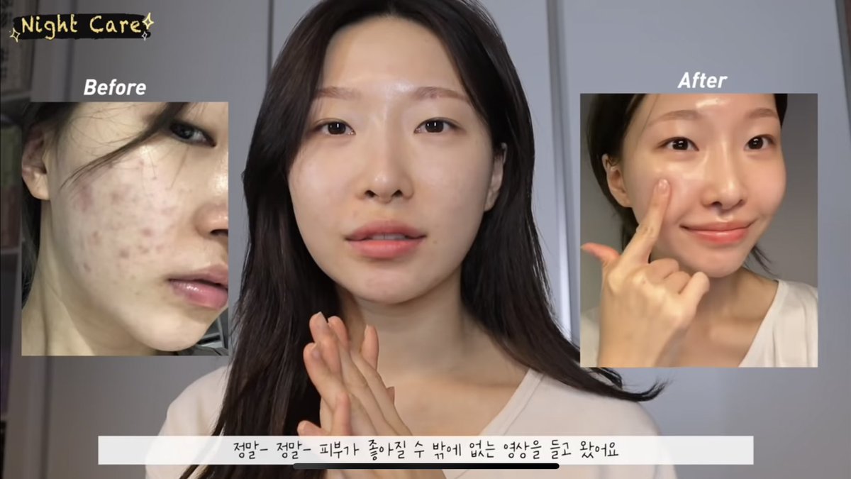 พสเกาหลีก็คืออวย toner pad ของ needly กันหนักมาก มันช่วยเรื่องสิวจริงแบบ 8000% สิวผด สิวอักเสบ สิวหัวดำ สิวอุดตันน้องคนนี้กินขาด ช่วยทั้งหมดเลย ดีมาก ไม่แปลกใจยอดขายเป็นหมื่นๆ กระปุก นี่ก็ใช้อยู่ดีจริงๆ ยืนยันนอนยัน🥹🫶🏻