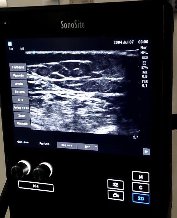 I hope this woman could go for a walk with her daughter this weekend. Stim Router electrode on tibial nerve