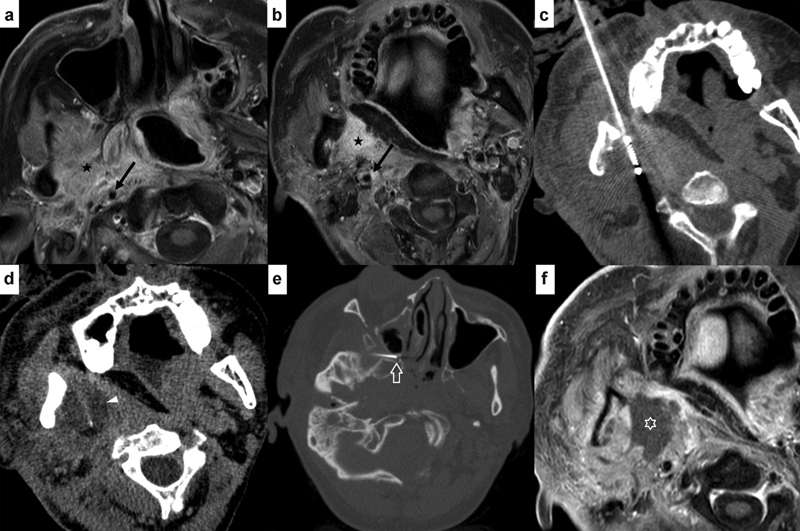SemInterventRad's tweet photo. This review article provides an overview and highlights the important #nuances of performing percutaneous #ablations in the #head and #neck.
Learn more https://t.co/KgVi7DCJpk
#headcance #neck #Cancer #interventionalradiology #cryoablation #cryoneurolysis https://t.co/kIn5YCzzis
