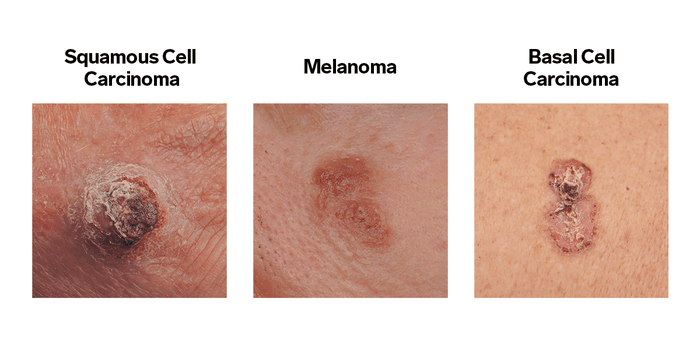 IMPACTMelanoma's tweet photo. #Melanoma is most easily treatable when detected early. Do you know what to look for and when to follow up with a doctor? Learn the signs of #SkinCancer: https://t.co/2ngbTc298f

#skincancerawareness #melanomaawareness #melanomawarrior #IMPACTMelanoma https://t.co/mBSEZKifT6