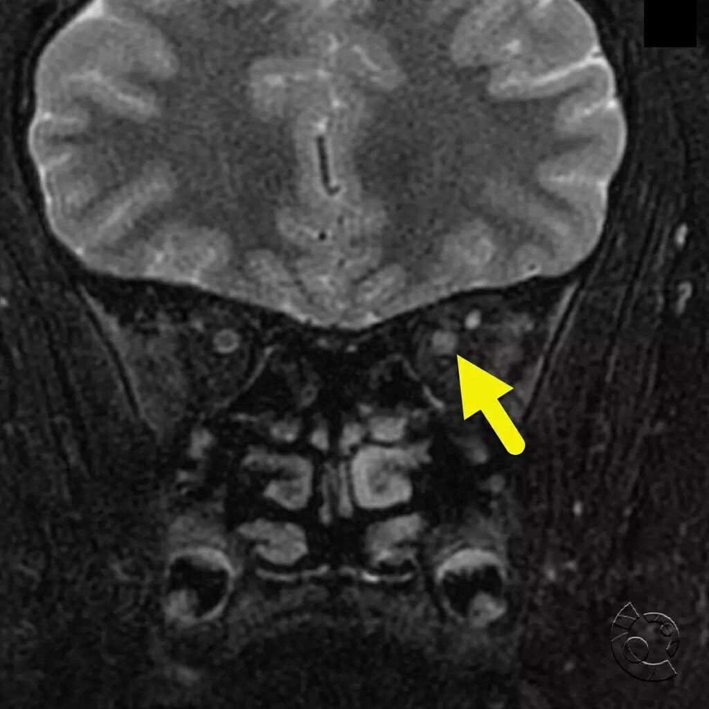 CincyKidsRad's tweet photo. Coronal T2-weighted (image 1) and axial T1-weighted postcontrast (image 2) MRI images show edema and inflammation of the left optic nerve (arrow) consistent with optic neuritis. Optic neuritis is the presenting feature of multiple sclerosis in 15-20 perc… https://t.co/3RW9jy4Ul0 https://t.co/fK8nSyHqZc