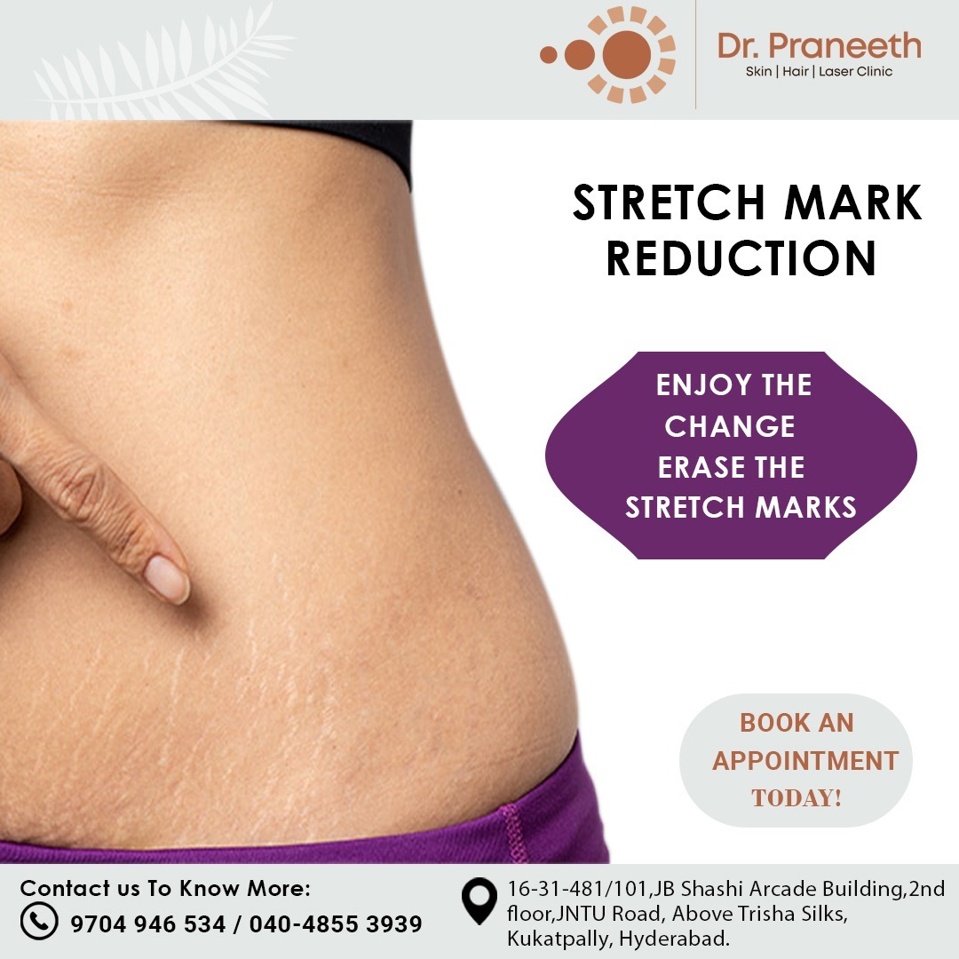 DrPraneethKumar's tweet photo. Stretch Mark Reduction
Enjoy the change erase the stretch marks
Visit - https://t.co/9ejlFHxmbt
Call for Appointment - 9704946534/040-48553939
#stretchmarkremoval #stretchmarktreatment #StretchmarksRemover #stretchmarksolution #fractionalco2laser #KPHB #Kukatpally https://t.co/6oEqe5Xi06