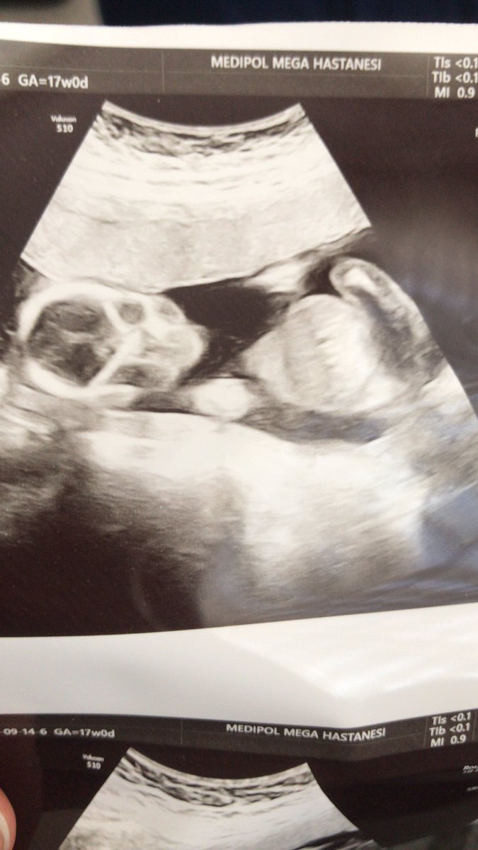 Herkesın çocuğuna laf ettikten sonra benım çocuğun ultrasyona yansıyan görüntüleri