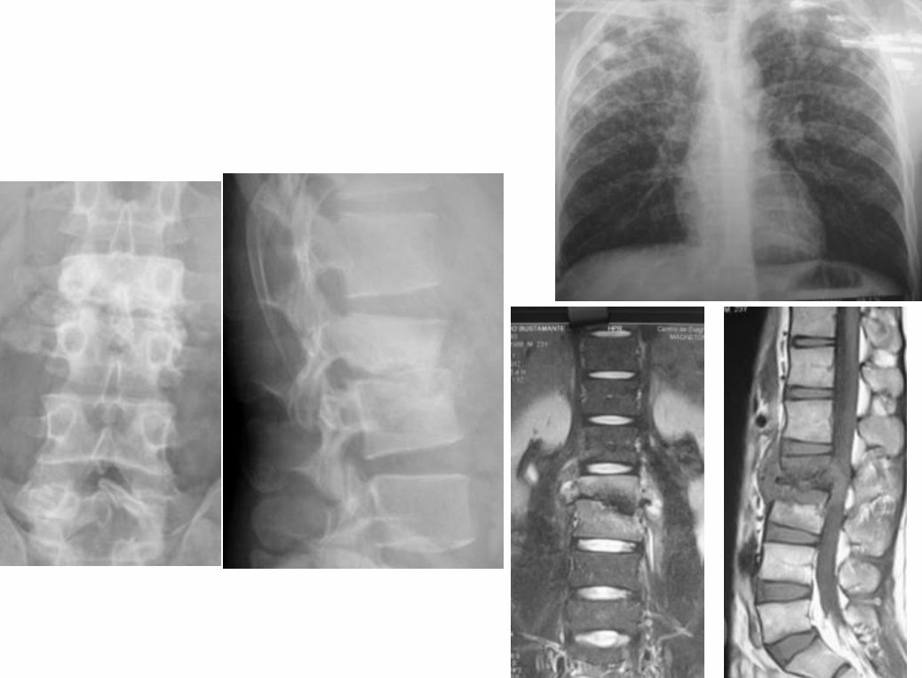 ConsejosReumato's tweet photo. Paciente con #tuberculosis pulmonar (BK de esputo +) y #espondilitis (#pott ). Hay compromiso o vertebral y de disco intervertebral, además absceso paravertebral. #spine #lumbalgia #lumbarpain #columnalumbar #psoasmuscle #acidfaststain #chest #XRAY #lung https://t.co/GLA1zXIcOs
