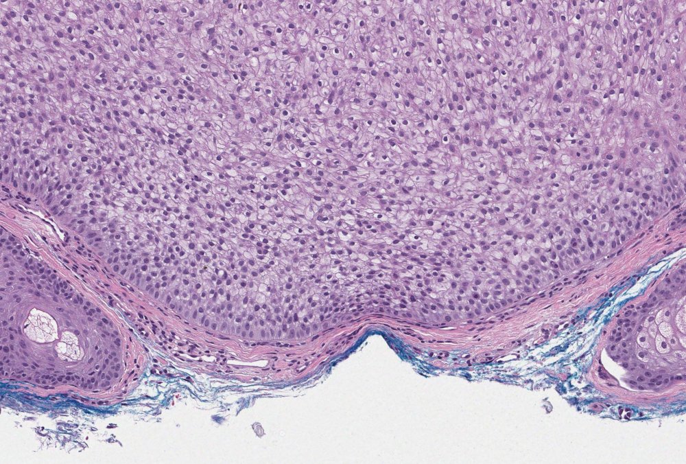 It is time for this week's #CaseOfTheWeek from <a href="/JasmineSaleh/">Jasmine Saleh, MD MPH</a> of #UMichPath

A solitary papule on the lip. A shave biopsy was performed. 

What is your diagnosis?
