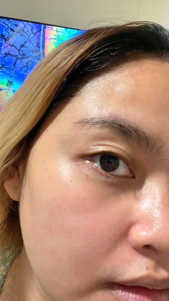 NGILANGIN BEKAS JERAWAT CUMAN 2 MINGGU!

From this                              to this!!!