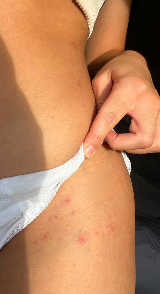 gracehamilton_x's tweet photo. Still awaiting my reply/full refund from our weekend stay at @dixiedeanhotel Me and the “bride to be “ shared the same bed and are both COVERED in bed bug bites from our stay. But no one at the hotel is taking this matter seriously! https://t.co/RXcuDWCkWW
