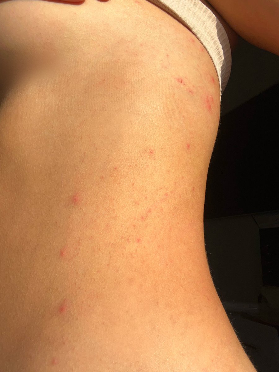 gracehamilton_x's tweet photo. Still awaiting my reply/full refund from our weekend stay at @dixiedeanhotel Me and the “bride to be “ shared the same bed and are both COVERED in bed bug bites from our stay. But no one at the hotel is taking this matter seriously! https://t.co/RXcuDWCkWW