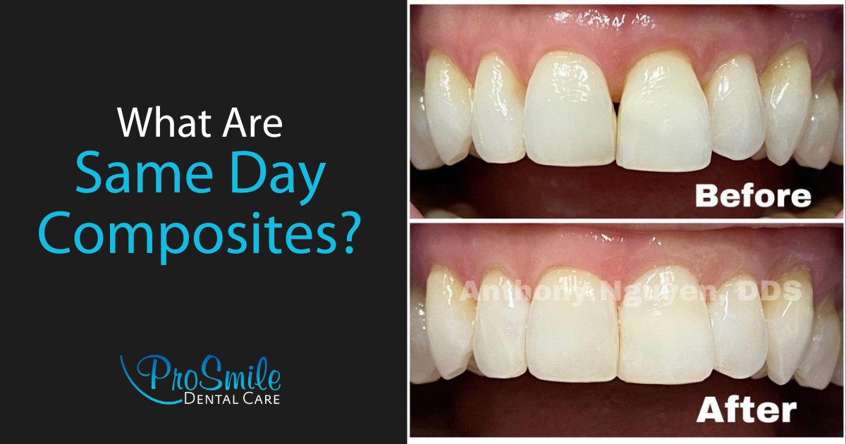 ProSmileDental2's tweet photo. Same day composites for a younger smile! 🦷✨ Find out more about how our advanced dentistry techniques can benefit you. 

#bayareadentist #prosmiledentalcare #dentalcrown #cerec #samedaycrowns #cerecdoctors #smiledesign #smilerehab #cereccrowns

https://t.co/S68Qlk0sOW https://t.co/ozxXCVoTeN