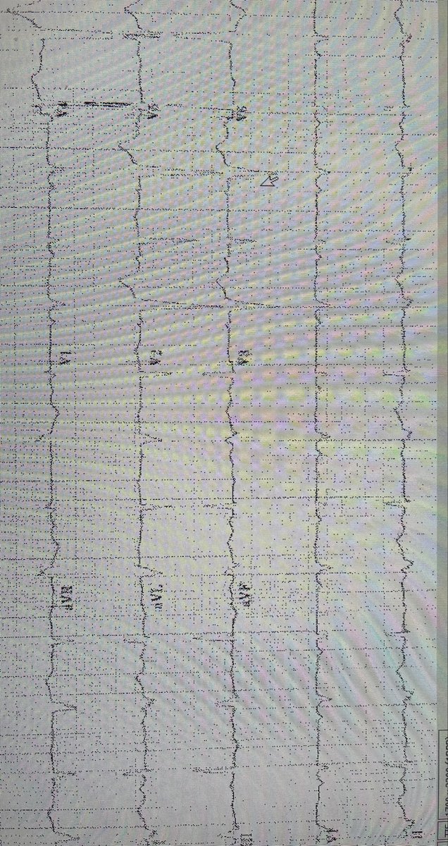 Reproduction is tough but any idea what is going on here? Things like this just bring out the ep nerd in me. #epeeps