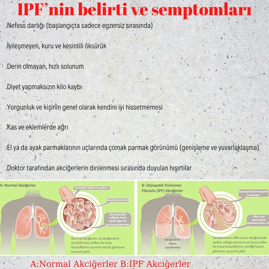 imunadir1's tweet photo. İPF NEDİR BELİRTİ VE SEMPTOMLARI NELERDİR? #idiyopatikpulmonerfibrözis #İPF #imünadir https://t.co/WE92QfPk8v
