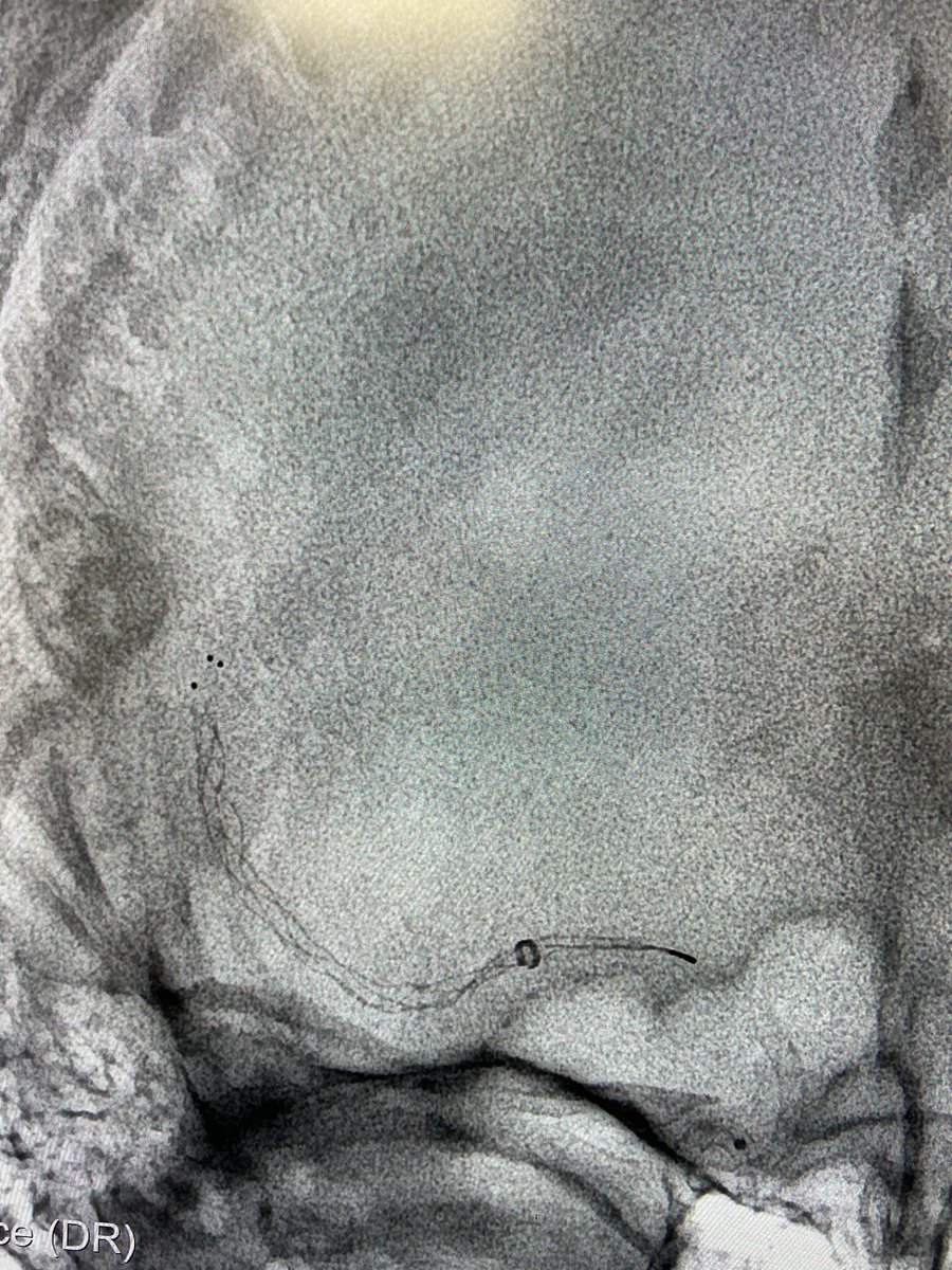 zafarhashim_INR's tweet image. My first case with the new RED68 catheter. Initial impression is very good  (good trackability and support for stentriever). @RadialFirstBot 😃 @AcuteStrokeUni1 @esmintsociety @SVIN_MT2020 @svinsociety @UKNGNeuro @brainconferenc1 what is everyone else’s experience?