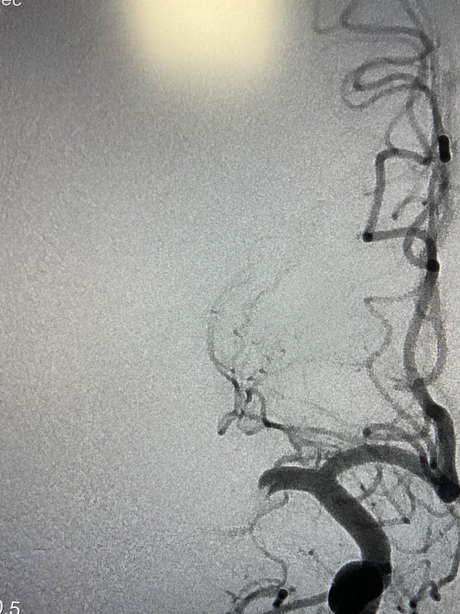 zafarhashim_INR's tweet image. My first case with the new RED68 catheter. Initial impression is very good  (good trackability and support for stentriever). @RadialFirstBot 😃 @AcuteStrokeUni1 @esmintsociety @SVIN_MT2020 @svinsociety @UKNGNeuro @brainconferenc1 what is everyone else’s experience?