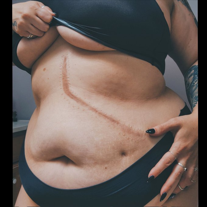 Cancer survivor, baby #cholangiocarcinoma #cancer #cancerawareness https://t.co/o4HDmRf4IJ<a href="/tag/cholangiocarcinoma"class="tags">#cholangiocarcinoma</a><a href="/tag/cancer"class="tags">#cancer</a><a href="/tag/cancerawareness"class="tags"><span>#cancerawareness</span></a>