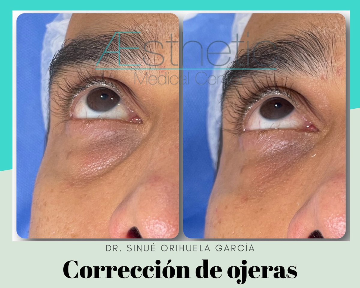 AestheticMC's tweet photo. El tratamiento de corrección de ojeras con ácido hialurónico de inmediato quita profundidad al surco y con los días su formulación exclusiva nos dará un efecto despigmentante que mejora el aspecto de la piel. 
#redensityII #teosyal #teoxane #ojeras #dermafillers #acidohialuronico https://t.co/64GXSI2PHe